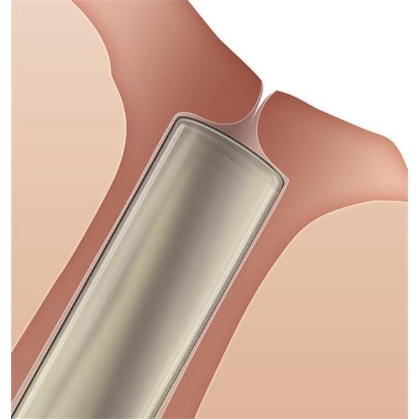 Plug Soft Plug Collagen 0.2x2mm 60/Bx